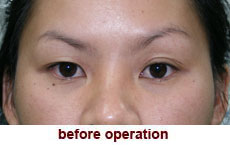 plastic-surgery-blepharoplasty